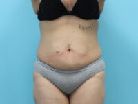 Abdominoplasty