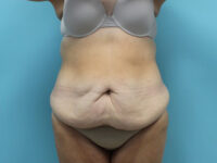 Abdominoplasty