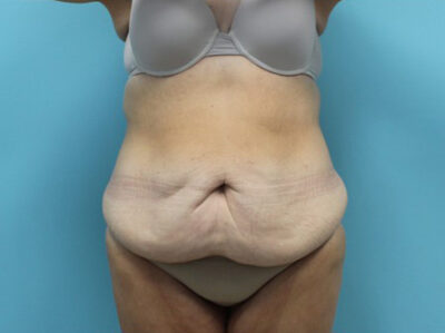 Abdominoplasty
