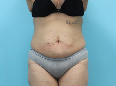 Abdominoplasty