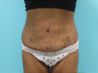 Abdominoplasty