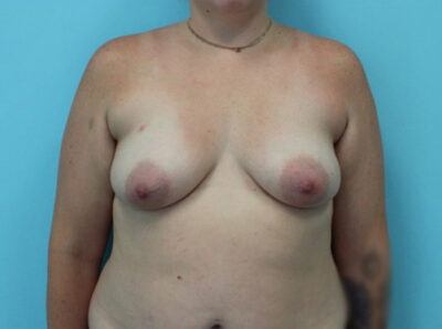 Augmentation & Mastopexy