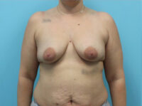 Augmentation & Mastopexy