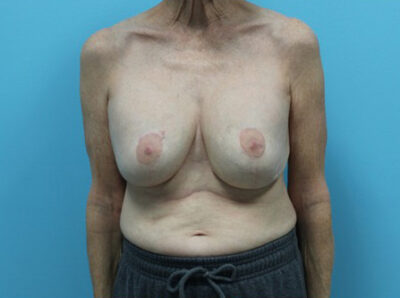 Augmentation & Mastopexy