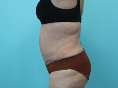 Abdominoplasty