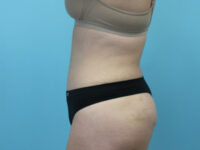 Abdominoplasty