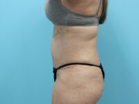 Abdominoplasty