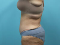 Abdominoplasty