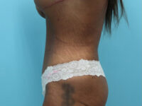 Abdominoplasty