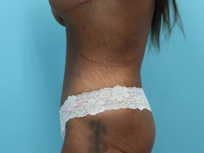 Abdominoplasty