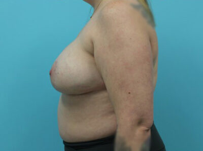 Augmentation & Mastopexy