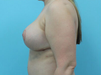 Augmentation & Mastopexy