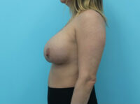 Breast Implant Exchange