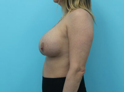 Breast Implant Exchange