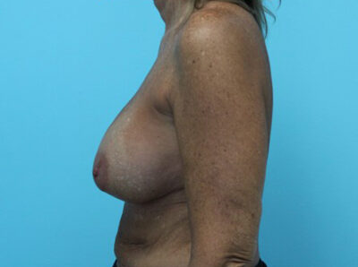 Breast Implant Exchange