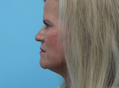Facelift