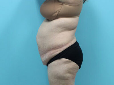 Abdominoplasty