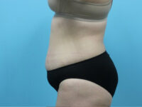 Abdominoplasty