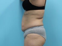Abdominoplasty