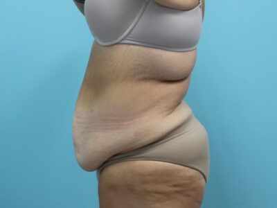 Abdominoplasty