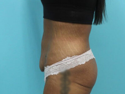 Abdominoplasty