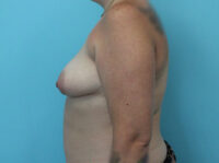 Augmentation & Mastopexy