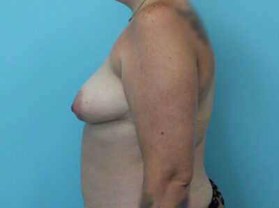 Augmentation & Mastopexy