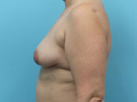 Augmentation & Mastopexy