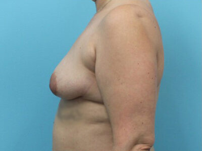 Augmentation & Mastopexy