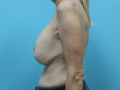 Augmentation & Mastopexy