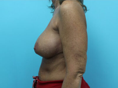Breast Implant Exchange