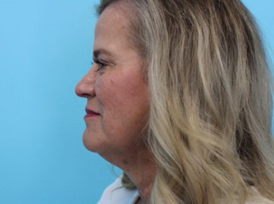 Facelift