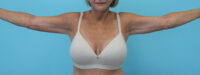 Brachioplasty