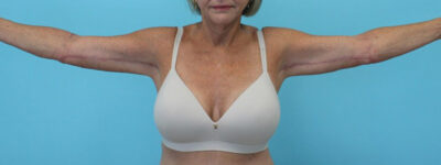 Brachioplasty