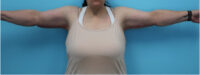 Brachioplasty