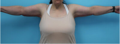Brachioplasty