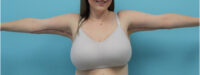 Brachioplasty