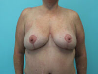 Mastopexy