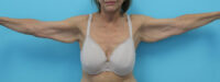 Brachioplasty