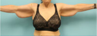 Brachioplasty
