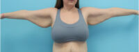 Brachioplasty