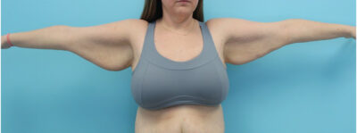 Brachioplasty