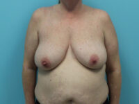 Mastopexy