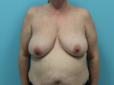 Mastopexy