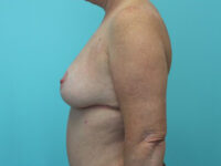 Mastopexy