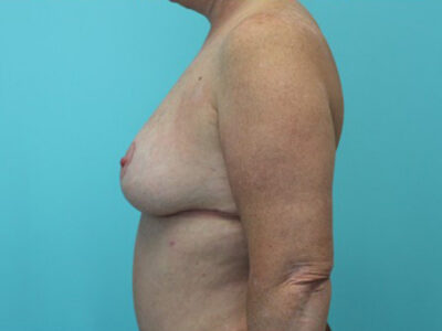 Mastopexy