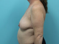Mastopexy