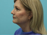Necklift