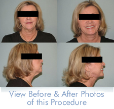 Neck lift before and after results at Parker Plastic Surgery in Athens