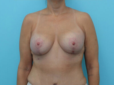 Augmentation & Mastopexy